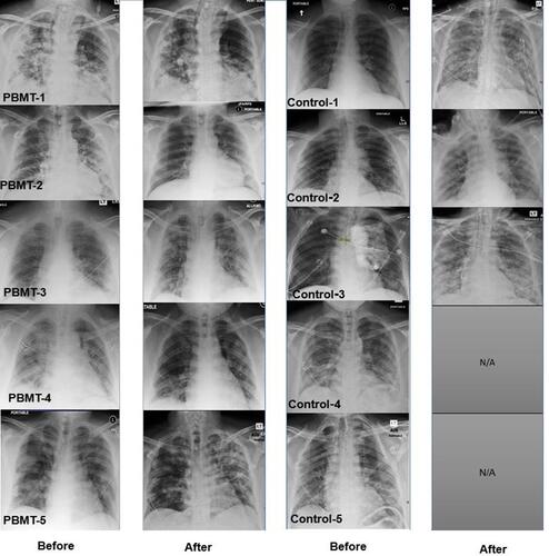Figure 5 Chest x-rays demonstrate visible improvement in the PBMT group and worsening in the control group. Chest x-rays before and after treatment reveal improved lucency, signifying increased absorption of consolidation and ground glass opacities in all PBMT treated patients. In three of five control patients, the chest x-rays show increased consolidation and ground glass opacities, signifying progression of disease (at the end of the observation period). Two control patients were discharged to home prior to obtaining post-treatment chest x-rays.