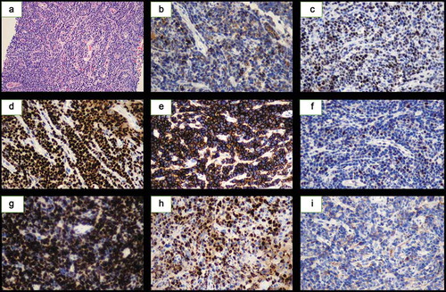 Figure 3. Microscopic examination of transformed DLBCL tissue samples. (a) Hematoxylin and eosin staining, × 200 magnification. Neoplastic cells were positive for BCL2 (b), BCL6 (c), PAX5 (d), CD20 (e), CMYC (f), KI67 (g), MUM1 (h), CD10 (i). Original magnification,  ×400.