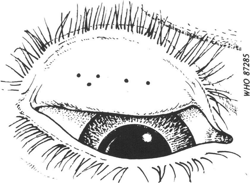 Figure 2. Sketch of an everted upper eyelid with five central conjunctival follicles of 0.5mm diameterCitation8 (© World Health Organization, reproduced with permission).
