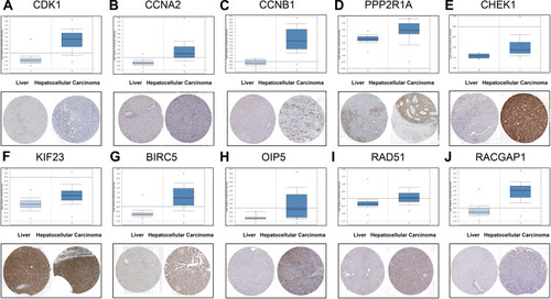 Figure 7 Validating the expression of 10 Hub genes on transcriptional and translational level by the Oncomine database and HPA database (immunohistochemistry). (A) CDK1. (B) CCNA2. (C) CCNB1. (D) PPP2R1A. (E) CHEK1. (F) KIF23. (G) BIRC5. (H) OIP5. (I) RAD51. (J) RACGAP1.