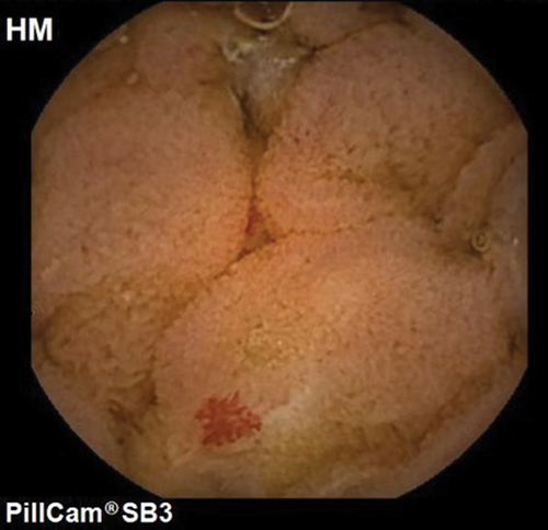 Figure 5. Small bowel capsule image of angioectasia.