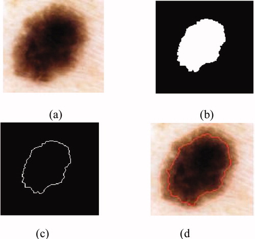 Figure 4. Result of the segmentation: (a) original image, (b) binary mask, (c) edge of the tumour, (d) segmented image.