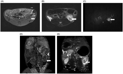 Figure 5. MRI findings of the VX2 tumors in the left kidney. (A) The 1.5-Tesla 3D-volumetric interpolated breath-hold examination T1-weighted imaging analysis showed a heterogeneous iso-low signal. (B) The VX2 tumor showed a circular low signal, as indicated by 1.5-Tesla fat suppression turbo spin-echo T2-weighted imaging analysis. (C) Diffusion-weighted imaging analysis showed that VX2 tumors exhibited a high signal. 3D-VIBE-T1WI (D) and FS-TSE-T2WI coronal (E) scans revealed that the tumor was located in the lower pole of the left kidney.