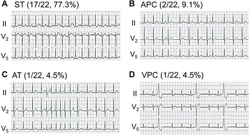 Figure 2 Representative ECG examples of cardiac arrhythmias, including sinus tachycardia (ST) (A), atrial premature contraction (APC) (B), atrial tachycardia (AT) (C), and ventricular premature contraction (VPC) (D).
