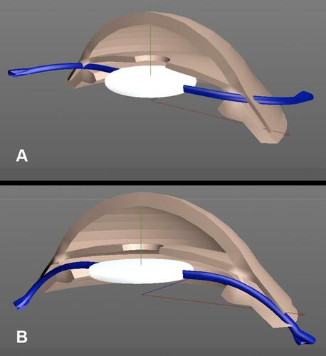 Figure 4 Schematic drawing of the sutureless intrascleral fixation “Catcher Pole” technique. (A) The haptics are normally designed with the prolene loop on the same plane of the optic disc or even 10° angulated anteriorly, if externalized through a simple sclerotomy they remain in the same plane of the optic disc off the scleral surface therefore free to slide back unless a stop is created. (B) With creation of a scleral tunnel tangent to the scleral surface, the haptics are forced to bend posteriorly for the whole length of the tunnel. The scleral tunnel costrains the haptic tendency to remain planar with optic disc or even more to move 10° anteriorly, such opposite forces contribute to fully stabilize the fixated IOL.