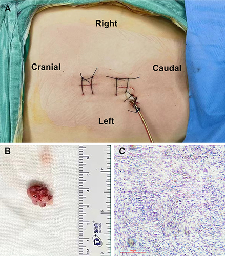 Figure 3 (A and B) The incisions and the resected tumor. (C) Hematoxylin and eosin (H&E) staining of the surgical biopsy specimen indicated that the tumor cells were arranged in bundles and swirls with gravel bodies evident, and their nuclei were ovoid or spindle-shaped.