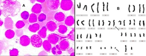 Figure 3 Bone marrow aspirate (1000×) using Wright stain and chromosome study on second admission. (A) A BM study revealed acute B-lymphoid leukemia. (B) A chromosome study revealed a karyotype of 46, XY, t(9; 22)(q34; q11) in all 20 cells analyzed.
