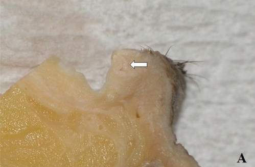 Figure 3A For an incision at 5 degrees lateral inclination to the sagittal plane, the slice includes the whole length of the vertical portion.