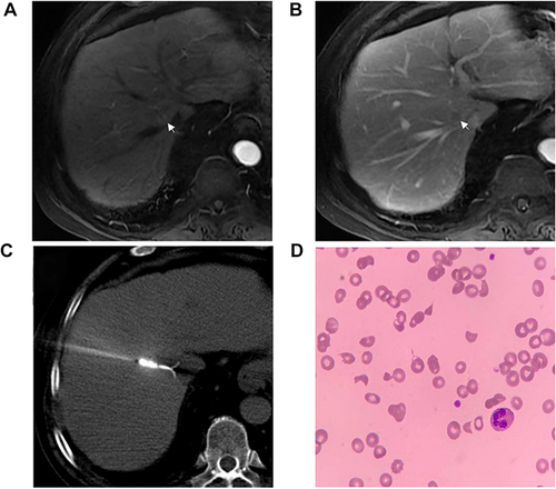 Figure 1 (A) Contrast-enhanced liver MRI, early arterial phase, showing a typical image of HCC lesions located in segment VIII, with significant contrast intake. (B) Delayed phase of enhanced liver MRI, showing the wash-out and pseudo-capsule appearance of HCC. (C) Computed tomography-guided radiofrequency ablation was performed to treat the HCC. (D) A peripheral blood smear showed numerous schistocytes.