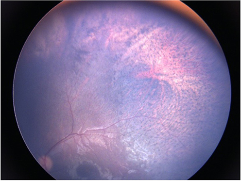 Figure 2 Fundus photography of retinal toxicity. “Salt-and-pepper” aspect around the intravitreal melphalan injection site. A fundus photograph of the right eye shows salt-and-pepper changes in the superotemporal quadrant. These changes are characterized by small, discrete white and black spots in the retina and retinal pigment epithelium. White spots are areas of retinal necrosis, while black spots are areas of retinal pigment epithelium atrophy. These changes are common side effects of intravitreal melphalan treatment for retinoblastoma.