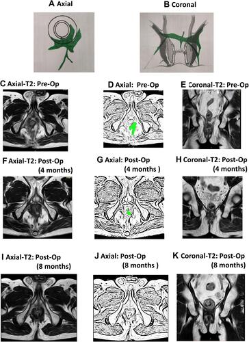 Figure 5 A 67-year-old male patient with a recurrent high transsphincteric horseshoe fistula. MRI done 4 months after surgery showed incomplete healing with a weighted score of 10 as per the new scoring system (NSS). The patient’s fistula healed, confirmed by MRI done at 7 months. The patient is asymptomatic after a follow-up of 30 months. (A) Axial section (schematic diagram); (B) Coronal section (schematic diagram); (C) Pre-operative axial T2-weighted MRI; (D) Sketch of figure-(C) (fistula shown in green color); (E) Pre-operative coronal T-2 weighted MRI; (F) Post-operative axial T2-weighted MRI showing fistula not healed at 4 months; (G) Sketch of Figure 5 (fistula shown in green color); (H) Post-operative coronal T2-weighted MRI showing fistula not healed at 4 months after surgery; (I) Post-operative axial T2-weighted MRI showing fistula healed 8 months after surgery; (J) Sketch of figure-(I); (K) Post-operative coronal T2-weighted MRI showing fistula healed 8 months after surgery.