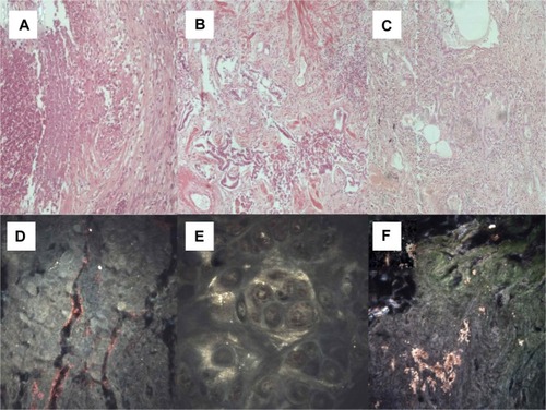 Figure 6 (A) Wegener’s granulomatosis (microscopic observation 100×). (B) Usual interstitial pneumonia (microscopic observation 100×). (C) Nonspecific interstitial pneumonia (microscopic observation 100 μm). (D) CytoViva® spectral imaging of Wegener’s granulomatosis, (E) usual interstitial pneumonia, and (F) nonspecific interstitial pneumonia.