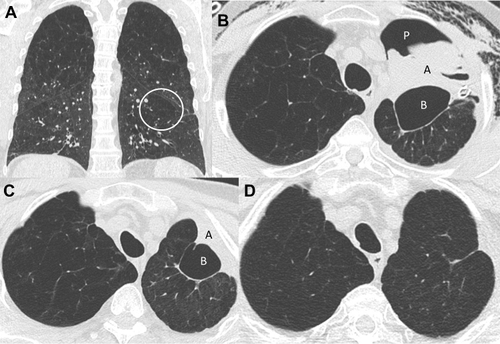 Figure 1 Chest CT evolution (patient 1). (A): Baseline chest CT before endobronchial valves insertion in the left upper lobe (LUL). The circle shows a low attenuation zone next to the fissure. (B): Chest CT performed 35 days after valves insertion. We can see the complete atelectasis of the LUL (A), presence of pneumothorax (P) with subcutaneous emphysema, chest tube drainage and occurrence of a new bulla (B) next to the fissure. (C): Chest CT performed 83 days after valves insertion. The air leak resolved and the bulla (B) size is decreasing. (D): Chest CT performed 508 days after valves insertion with a complete resolution of the bulla.