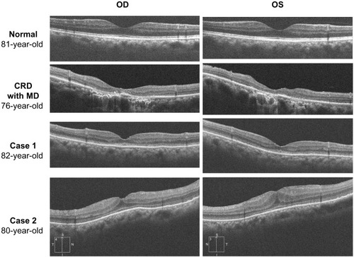 Figure 6 Results of optical coherence tomography.