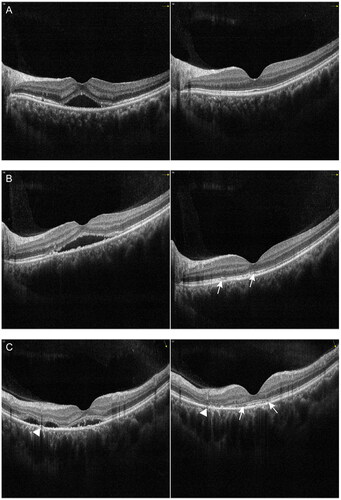 Figure 4. Examples of the change in serous subretinal fluid (SRF) with spectral domain optical coherence tomography (SD-OCT) in patients with chronic central serous chorioretinopathy (cCSC) after subthreshold micropulse laser (SML). The left panel represents SD-OCT B-scan images at baseline visit, the right panel represents SD-OCT B-scan images at one-month follow-up visit after SML. (A) SD-OCT B-scan at baseline showed sub-macular SRF from the left eye of a 39-year-old male patient (left). At the one-month visit after SML treatment, SRF were completely resolved, the ellipsoid zone and RPE were intact (right). (B) SD-OCT B-scan at baseline showed sub-macular SRF from the left eye of a 43-year-old male patient (left). At the one-month visit, SRF were completely resolved, however, disruptions in the ellipsoid zone can be visible (arrow) (right). (C) SD-OCT B-scan at baseline showed presence of SRF and irregularly appeared RPE from the left eye of a 52-year-old male patient (left). The HFs were visible between the ellipsoid zone and RPE. Small irregular PED was visible (arrowhead). At the one-month visit, SRF were resolved, however, discontinuous ellipsoid zone was visible (arrow), the disruptions in RPE remained visible (arrowhead) (right).