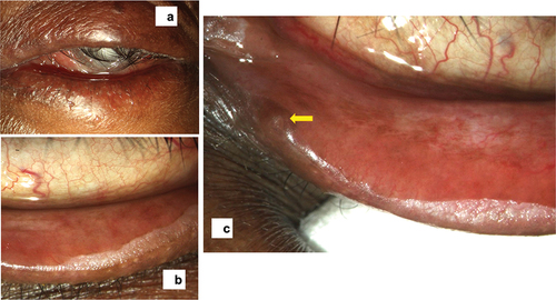 Figure 2. Lid changes in the form of entropion (a), lid margin keratinization (b), and punctal stenosis (c).