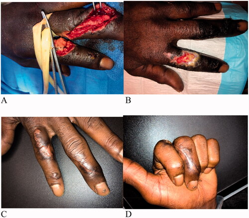 Figure 2. Case 2. A 65-year-old male admitted to the hospital for injuries to his dorsal 2nd and 3rd fingers, after a table saw injury (A). The injury to the left index finger was inclusive of a unicortical fracture of the proximal phalanx with an absence of periosteum. After debridement of the dorsal 2nd finger, a sheet of IMBWM was applied to the wound. Vascularization of the dermal matrix on the dorsal 2nd finger occurred sequentially (B and C) and continued 3 weeks after placement, at which time the silicone layer was removed. To allow for time for sequential vascularization of the IMBWM to occur, the wound was subsequently allowed to heal by secondary intention. Patient recovered full ROM on his 2nd finger with a fully healed reconstruction, after 12 weeks of treatment (D).