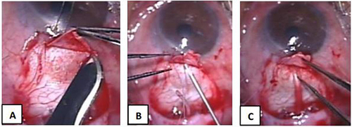 Figure 2 Ahmed Glaucoma Valve Implantation using the SNT technique (A–C). (A) Creation of a 4 mm (L) x 5 mm (W) scleral flap; (B) 2 mm short needle track created with a G-23 needle; (C) Insertion of Ahmed tube with 1–1.5mm intracameral portion.