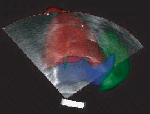 Figure 4. a) AtamaiViewer screen-shot showing real-time intra-operative TEE data augmented with anatomical context provided by the pre-operative heart model using the feature-based registration. [Color version available online.]
