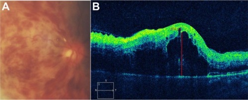 Figure 45 Central retinal vein occlusion with macular edema.