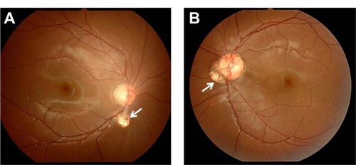 Figure 5 Case 2: funduscopy findings.