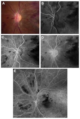 Figure 3 (A) Color photograph of the left eye 1 month after presentation revealing neovascularization of the disk. (B, C and D) Early, mid, and late fluorescein angiograms of the left eye at the same visit demonstrating leakage of the disk consistent with neovascularization. (E) Fluorescein angiogram of the mid-periphery revealing ischemia superonasal to the disk.