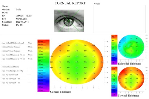 Figure 2 Corneal report produced by the Zeus software showing total corneal, epithelial, and stromal thickness pachymetry maps over 8 mm diameter.
