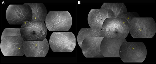 Figure 2 Fluorescein angiographic images of the right (A) and left (B) eyes.