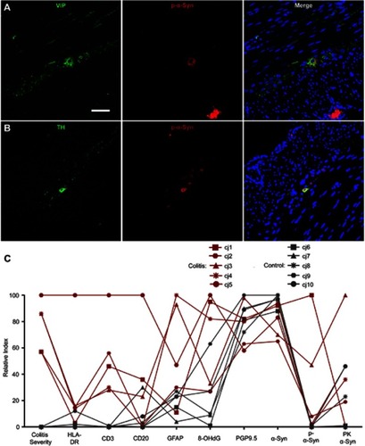 Figure 4 Phosphorylated α-syn was present in multiple myenteric neuronal populations in marmosets with colitis and comparing immunohistochemical markers in each animal reveals group and individual subject trends. (A and B) Immunofluorescent co-labeling of p-α-syn with (A) VIP or (B) TH in myenteric ganglia. Scale bar =50 μm. (C) Graph displaying colitis score and immunohistochemical marker data from each animal as percentage of maximum value (relative index) in each dataset.Abbreviations: p-α-syn, alpha-synuclein phosphorylated at serine 129; VIP, vasoactive intestinal peptide; TH, tyrosine hydroxylase; HLA-DR, human leukocyte antigen DR; CD3, cluster of differentiation 3; CD20, cluster of differentiation 20; GFAP, glial fibrillary acidic protein; 8-OHdG, 8-hydroxy-2’-deoxyguanosine; PGP9.5, protein gene product 9.5; α-syn, alpha-synuclein; PK α-syn, aggregated α-syn resistant to proteinase K treatment.