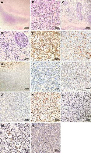 Figure 3 Histopathologic features and immunohistochemical findings of the tumor. (A) Diffuse infiltration of lymphoma cells and extensive areas of necrosis. (hematoxylin and eosin, original magnification ×40). (B) The tumor cells were medium size with irregularly folded nuclei and indistinct nucleoli. The cytoplasm was moderate and easy to find mitotic figures. (hematoxylin and eosin, original magnification ×400). (C) The lymphocytes showed an angiocentric growth pattern. (hematoxylin and eosin, original magnification ×200). (D) Angiodestructive growth pattern is found. (hematoxylin and eosin, original magnification ×400). The tumor cells were positive for CD3 (E), CD4 (F), CD56 (G), granzyme B (I) and TIA-1 (J), Ki-67 (K, with a proliferation index approximately 80%), EBERs (L), PD1 (M), PD-L1 (N). The tumor cells were negative for CD20 (H). Original magnification in (E and F, H–N) is ×400 and (G) is ×200.