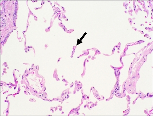 Figure 2 Histologic features of centrilobular emphysema. A section of lung tissue shows fragmented and “free-floating” alveolar septa (arrow) characteristic of emphysema.
