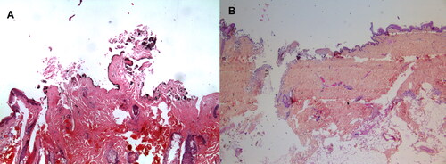 Figure 7. Microscopical aspects of these shrapnel-like injuries. The origin of the wounds is distinguished by the presence (A) or absence (B) of gun powder particles (hematein stain combined with an aluminum mordant, ×100).