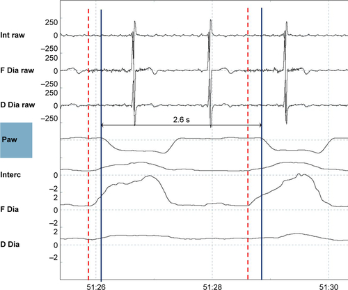 Figure S2 A pressure-supported (PS) breath.Notes: Shown are (from top to bottom) the raw intercostal signal (Int raw), the raw frontal diaphragm signal (F Dia raw), the raw dorsal diaphragm signal (D Dia raw), the pressure wave (Paw), the average intercostal signal (Interc), the average frontal diaphragm (F Dia) signal, and the average dorsal diaphragm signal (D Dia). Two PS breaths are shown, as electromyography activity (the dotted red line) precedes the pressure wave (the straight blue line). A low backup frequency of 10 breaths/min was set on the ventilator, therefore a 2.6 s time in-between the breaths confirms that breaths were PS and not pressure-controlled (PC).Abbreviation: EMG, electromyography.