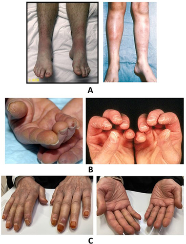 Figure 4 (A) Erythema nodosum: notice the reddish, lumpy appearance. Copyright (2022) ACR.; (B) mechanic’s hands: notice the irregular, broadly horizontal cracking of skin giving a dirty appearance. Fissures are hyperpigmented; (C) notice skin tightening of fingers.