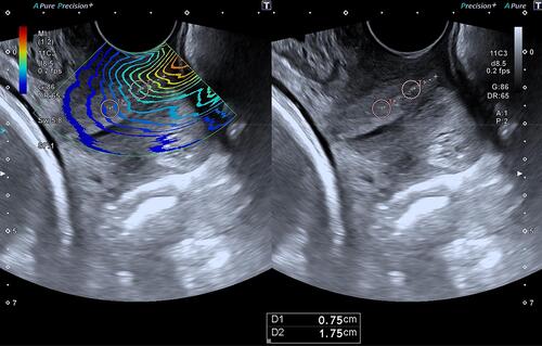 Figure 2 Schematic diagram of a twin view for measurement sites. A(left): elastographic map, B(right): grey-scale B mode that the measurement was done at the anterior lip of cervix 7.5 mm (lower point) and 17.5 mm (upper point) from the external cervical os.