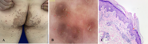 Figure 1 Clinical manifestation and histopathological findings of Porokeratosis Ptychotropica. (A) Clinical features show “butterfly shaped” verrucous plaque on buttocks with multiple satellite papules. (B) Dermoscopic view (X10) of the skin lesion, similar to keratotic ridge: annular, brown-yellowish hyperkeratotic ridge (arrows) demarcating a central area with whitish scales and some globular vessels. (C) A histological hallmark of all variants of porokeratosis, cornoid lamella (CL) as a “column” overlying a zone of the epidermis (cornoid lamella, marked as red asterisk). Dyskeratotic cells and focal hypogranulosis were present in the epidermis underlying the CL. Here, localized subcutaneous inflammatory cells infiltration suggested an eruptive pruritic PPt (H&E staining, X100).
