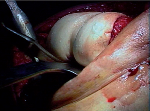 Figure 2. Remodeling of posterior condyles with a curved osteotome.