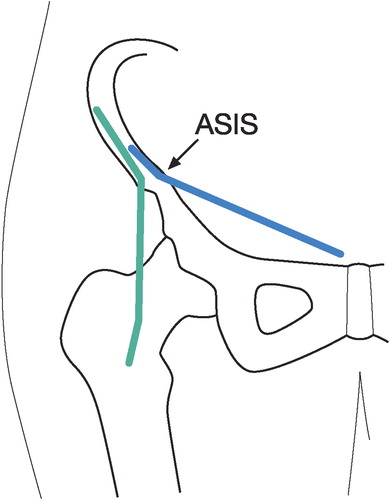 Figure 4. Incisions of the Modified Smith-Petersen (green) and ilioinguinal (blue) approaches. The anterior superior iliac spine is marked ASIS.