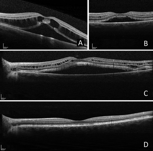 FIGURE 4. Optical coherence tomographic (OCT) images of the left eye: changes more pronounced than in the right eye. (A) At diagnosis: serous detachment of the neurosensory retina and intraretinal fluid. (B) Exudate decreased following the institution of topical treatment. (C) Recurrence of serous detachment of the neurosensory retina and intraretinal fluid prior to systemic treatment. (D) Exudate regressed after 6 months of systemic treatment.