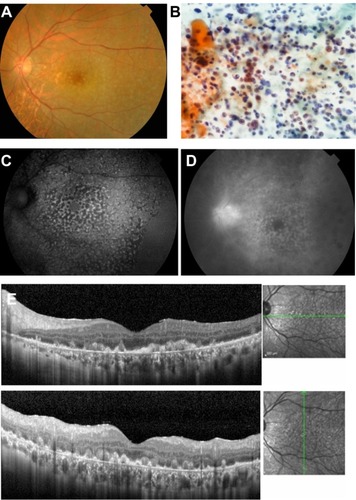 Figure 2 Case 2. Fundus images of the left eye in a 57-year-old man with primary intraocular lymphoma after vitrectomy.