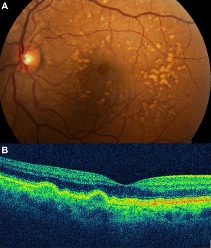 Figure 3 (A) Color photograph. (B) Cirrus™ optical coherence tomography image.