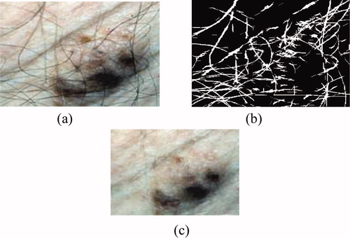 Figure 2. Hair removal by the DullRazor technique: (a) original image, (b) mask hairs, (c) image after removal of hair.
