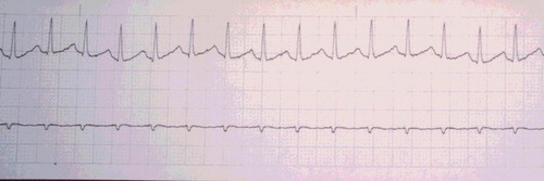 Figure 1. Maternal rhythm strip showing narrow complex sinus tachycardia 2 hr and 15 min post ingestion.