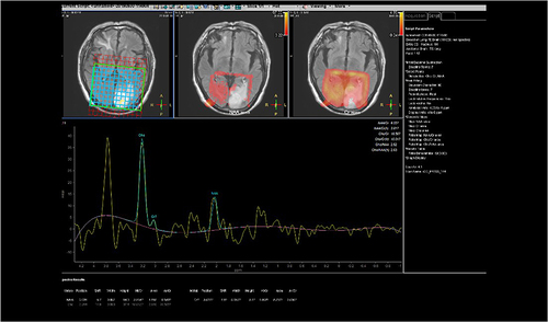 Figure 7 Male (68 years old) with dizziness for twenty days. Magnetic resonance spectroscopy showing the internal choline peak of the tumor was significantly increased, creatinine peak was obviously decreased, and the N-acetylaspartate peak was decreased.
