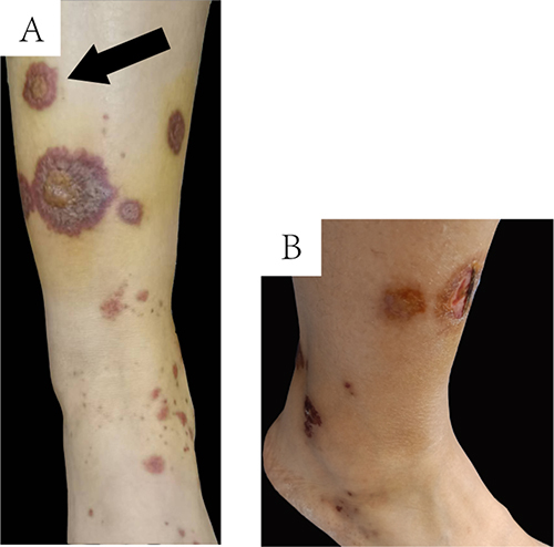 Figure 1 The cutaneous manifestation. (A) The maculopapular rash in dark purple appeared on the lower extremities; (B) The lesion in the pretibial skin rapidly progressed into 1-centimeter-sized ulcer.