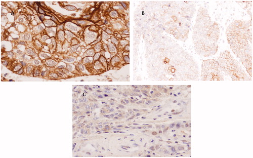 Figure 4. Immunohistochemical staining of DSG3 in SCC. (A) Well differentiated SCC with intense positivity mainly in cell membranes (40×). (B) More heterogeneous staining in cell membranes and some cytoplasms (20×). (C) Faint cytoplasmic/nuclear staining in poorly differentiated area (40×).