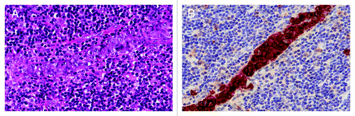 Figure 2. Systemic anaplastic large cell lymphoma. (A) Hematoxylin and eosin (H&E) staining showing large pleomorphic tumor cells with an intrasinusoidal growth pattern and (B) homogeneous expression of CD30.