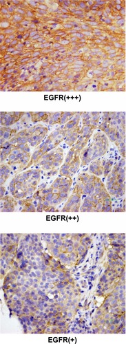 Figure 2 The representative pictures of EFGR expression with (+) to (+++) staining.