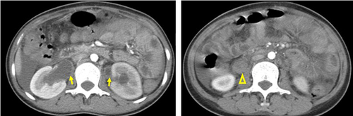 Figure 3 Axial CECT at respective levels (of Figure 1) (left and right); note how a hematoma could be easily missed as an “enhancing” mass lesion (arrows and arrow head) had the CECT only been seen.