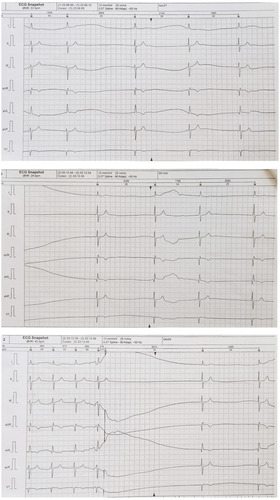 Figure 6 24h ECG Holter Monitoring showing permanent atrial fibrillation with low heart rates (spontaneous average 24h heart rate 52 bpm and limits between 25–84 beats per minute) and multiple and prolonged pauses (max. 3.9 s) and intermittent periods of complete heart block.